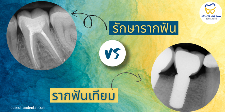 รักษารากฟัน ไม่ใช่ รากฟันเทียม