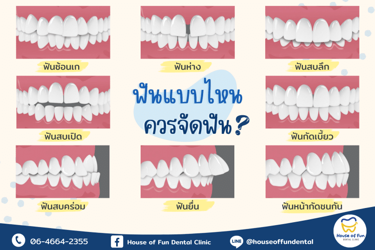 ฟันแบบไหนควรจัดฟัน?